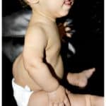 Kyphosis in Children with Achondroplasia Feature Photo